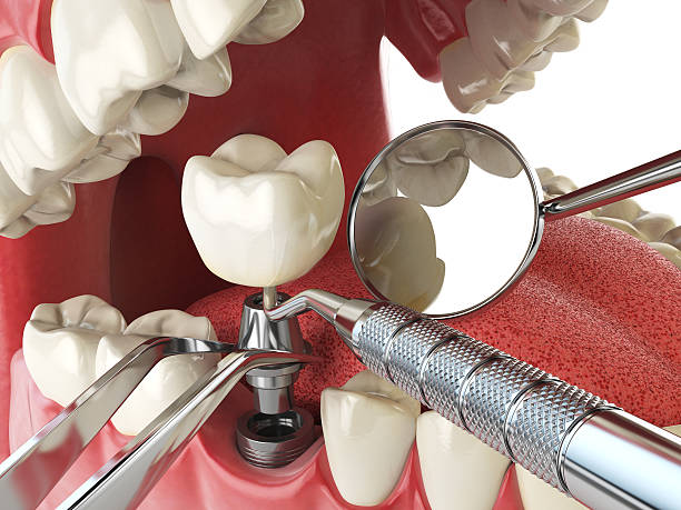 Best Emergency Dentist for Lost Fillings or Crowns in Battle Creek, MI